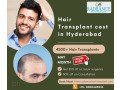 best-hair-transplant-cost-hyderabad-compare-save-small-0
