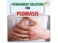 understanding-psoriasis-what-it-is-and-what-is-the-treatment-of-it-small-0