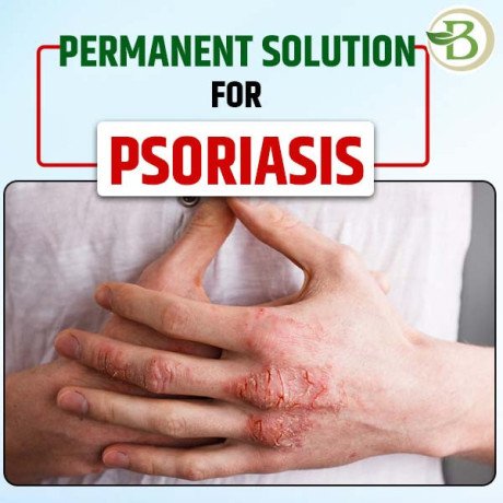 understanding-psoriasis-what-it-is-and-what-is-the-treatment-of-it-big-0