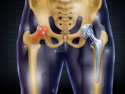 best-hip-replacement-surgeon-in-delhi-dr-kheras-wellness-clinic-big-0