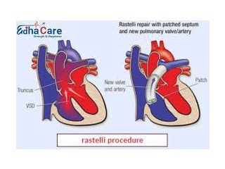 Best Rastelli Procedure Using Advanced Technology